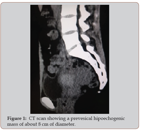 Click here to view Large Figure 1 irispublishers-openaccess-gynecology-womens-health