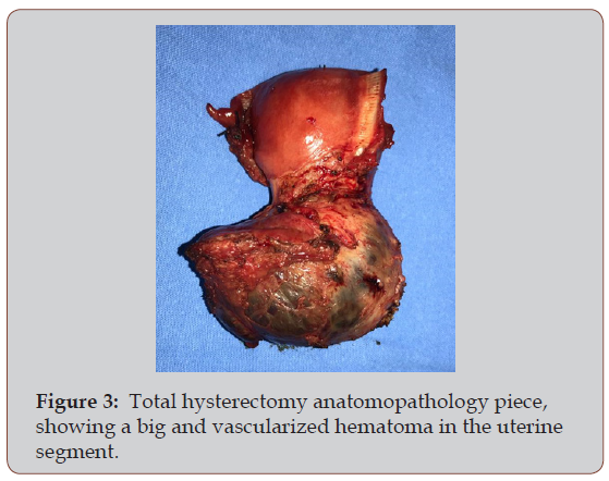 Click here to view Large Figure 3 irispublishers-openaccess-gynecology-womens-health