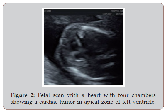 Click here to view Large Figure 2 irispublishers-openaccess-gynecology-womens-health