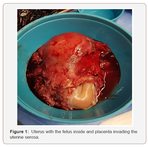 Click here to view Large Figure 1 irispublishers-openaccess-gynecology-womens-health