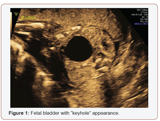 Click here to view Large Figure 1 irispublishers-openaccess-gynecology-womens-health