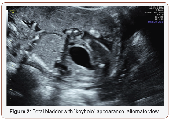 Click here to view Large Figure 2 irispublishers-openaccess-gynecology-womens-health