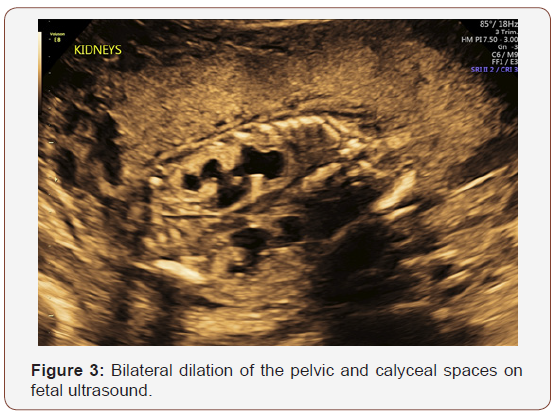 Click here to view Large Figure 3 irispublishers-openaccess-gynecology-womens-health