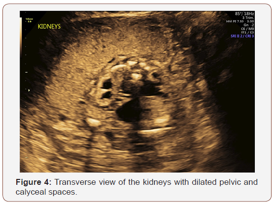 Click here to view Large Figure 4 irispublishers-openaccess-gynecology-womens-health