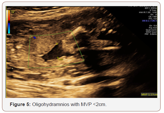 Click here to view Large Figure 5 irispublishers-openaccess-gynecology-womens-health