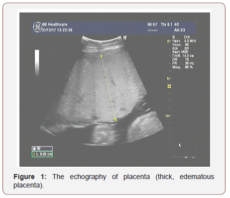 Click here to view Large Figure 1 irispublishers-openaccess-gynecology-womens-health
