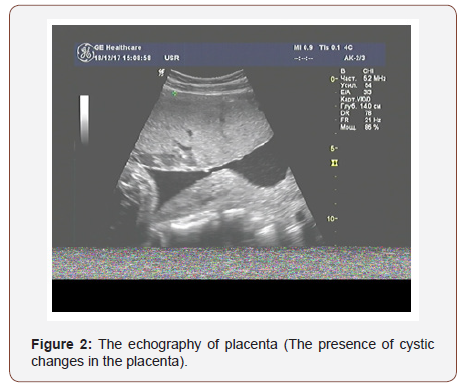 Click here to view Large Figure 2 irispublishers-openaccess-gynecology-womens-health
