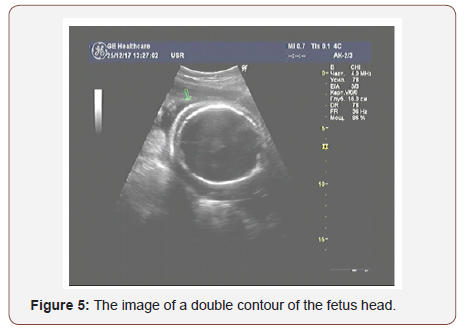 Click here to view Large Figure 4 irispublishers-openaccess-gynecology-womens-health