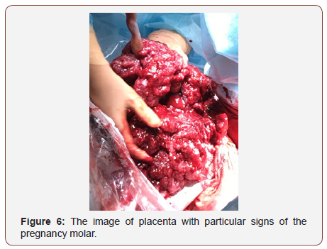 Click here to view Large Figure 5 irispublishers-openaccess-gynecology-womens-health