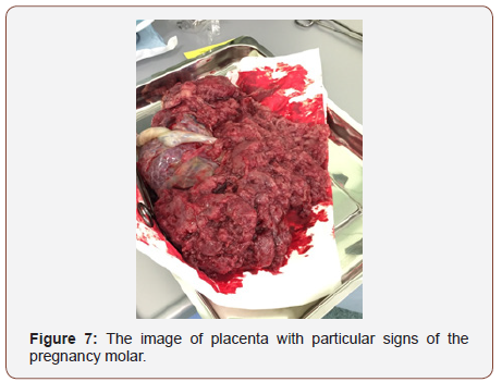 Click here to view Large Figure 6 irispublishers-openaccess-gynecology-womens-health