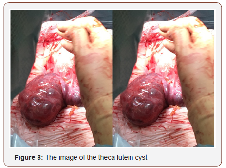 Click here to view Large Figure 7 irispublishers-openaccess-gynecology-womens-health