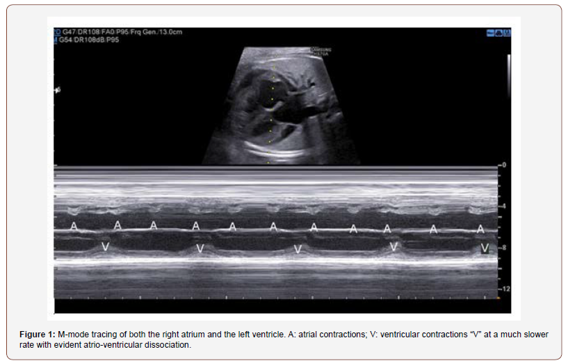 Click here to view Large Figure 1 irispublishers-openaccess-gynecology-womens-health