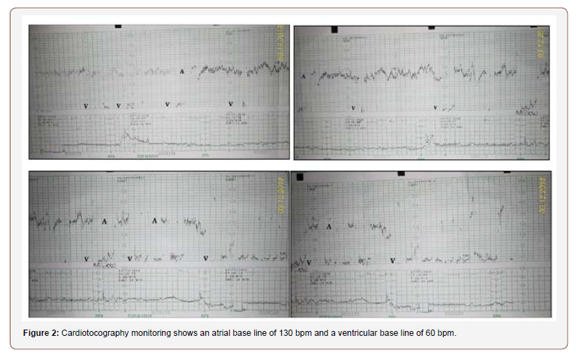 Click here to view Large Figure 2 irispublishers-openaccess-gynecology-womens-health
