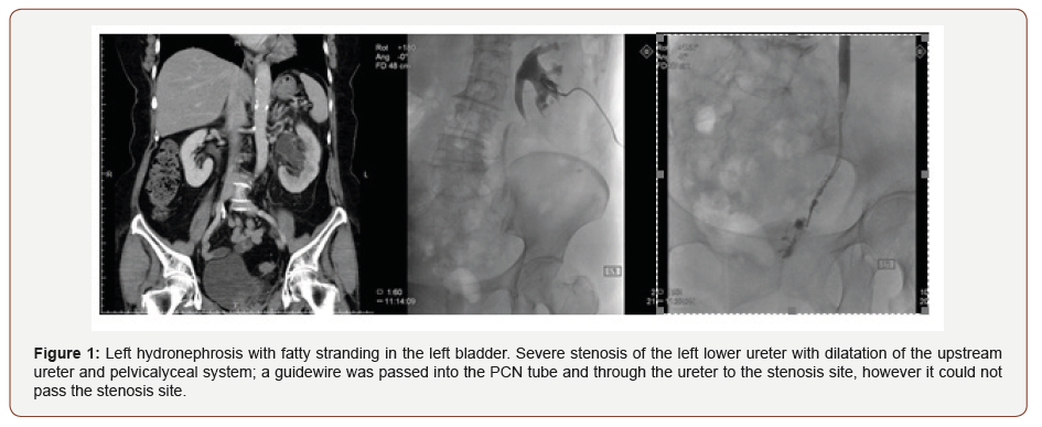 Click here to view Large Figure 1 irispublishers-openaccess-gynecology-womens-health