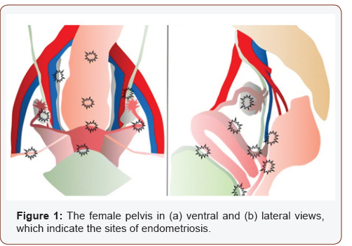Click here to view Large Figure 1 irispublishers-openaccess-gynecology-womens-health