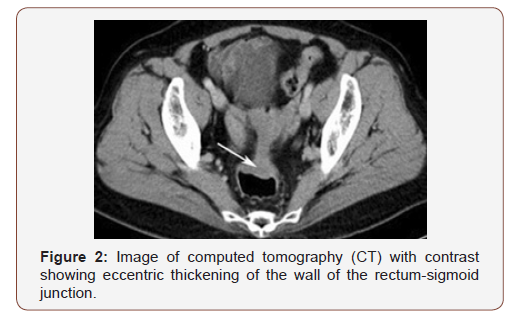 Click here to view Large Figure 2 irispublishers-openaccess-gynecology-womens-health