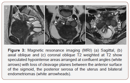 Click here to view Large Figure 3 irispublishers-openaccess-gynecology-womens-health