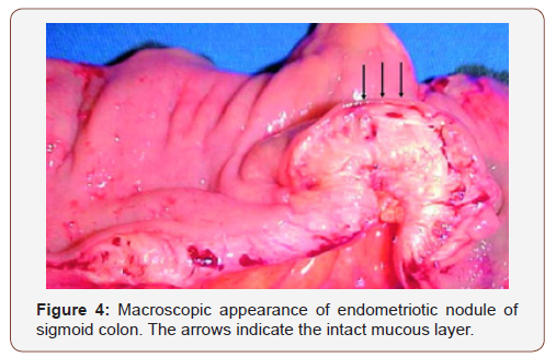 Click here to view Large Figure 4 irispublishers-openaccess-gynecology-womens-health