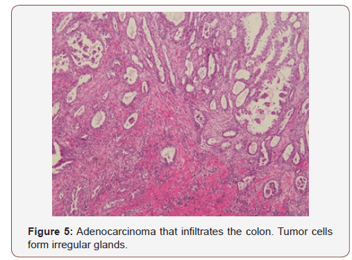 Click here to view Large Figure 5 irispublishers-openaccess-gynecology-womens-health