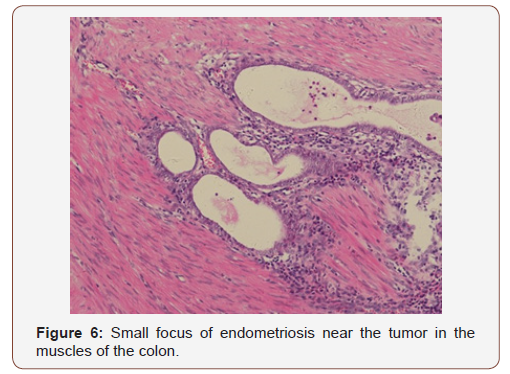 Click here to view Large Figure 6 irispublishers-openaccess-gynecology-womens-health