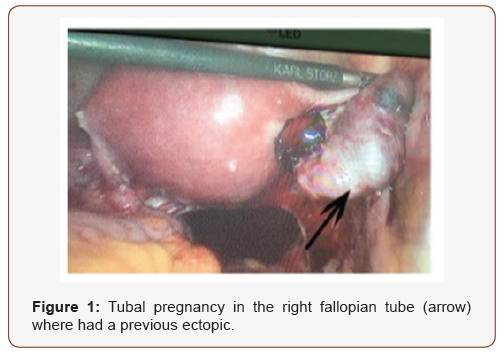 Click here to view Large Figure 1 irispublishers-openaccess-gynecology-womens-health
