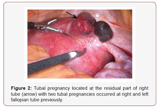 Click here to view Large Figure 2 irispublishers-openaccess-gynecology-womens-health