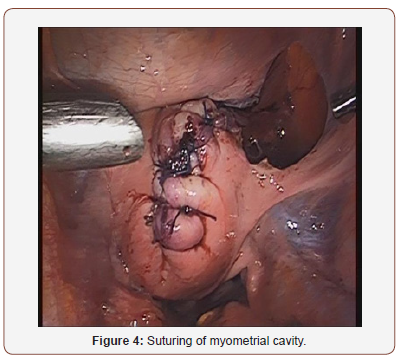 Click here to view Large Figure 4 irispublishers-openaccess-gynecology-womens-health