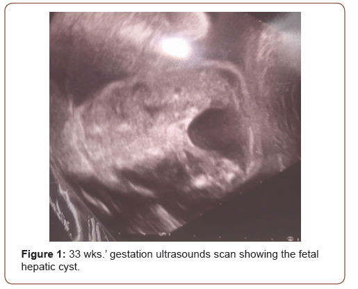 Click here to view Large Figure 1 irispublishers-openaccess-gynecology-womens-health