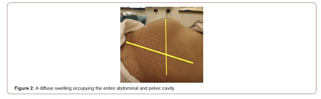 Click here to view Large Figure 2 irispublishers-openaccess-gynecology-womens-health