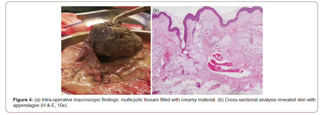 Click here to view Large Figure 4 irispublishers-openaccess-gynecology-womens-health