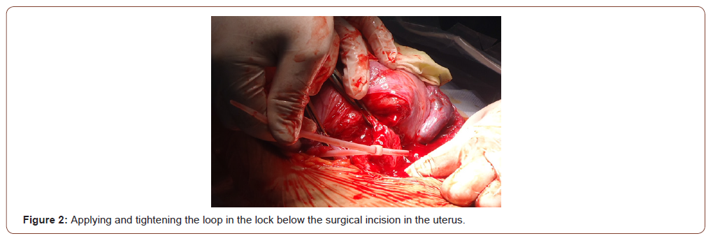 Click here to view Large Figure 2 irispublishers-openaccess-gynecology-womens-health