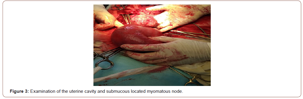 Click here to view Large Figure 3 irispublishers-openaccess-gynecology-womens-health