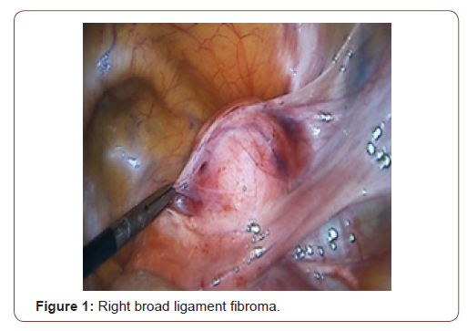 Click here to view Large Figure 1 irispublishers-openaccess-gynecology-womens-health