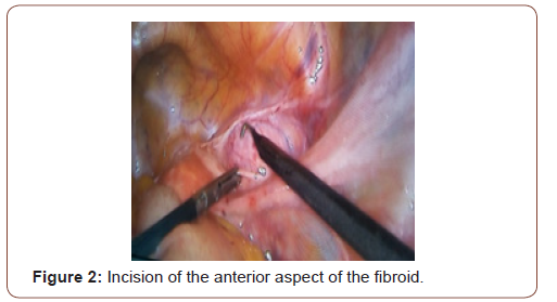 Click here to view Large Figure 2 irispublishers-openaccess-gynecology-womens-health