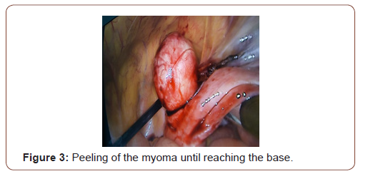 Click here to view Large Figure 3 irispublishers-openaccess-gynecology-womens-health
