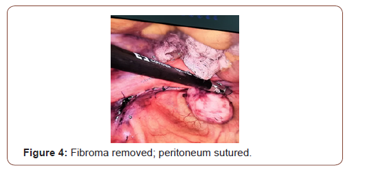 Click here to view Large Figure 4 irispublishers-openaccess-gynecology-womens-health