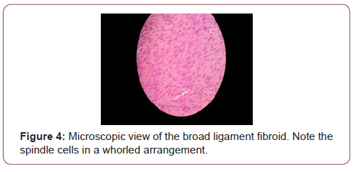 Click here to view Large Figure 5 irispublishers-openaccess-gynecology-womens-health