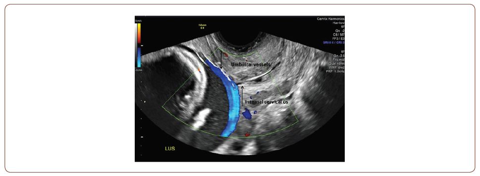 Click here to view Large Figure 1 irispublishers-openaccess-gynecology-womens-health