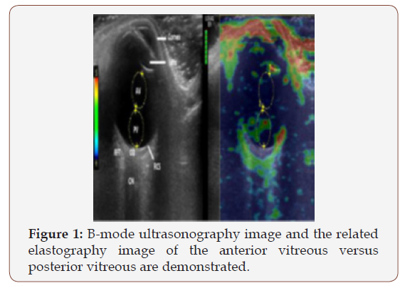 Click here to view Large Figure 1 irispublishers-openaccess-ophthalmology-vision-research