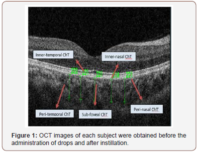 Click here to view Large Figure 1 irispublishers-openaccess-ophthalmology-vision-research
