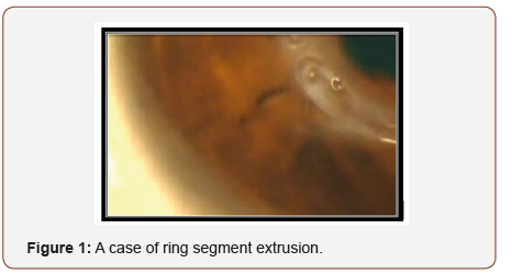 Click here to view Large Figure 1 irispublishers-openaccess-ophthalmology-vision-research