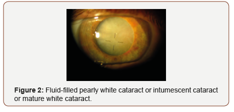 Click here to view Large Figure 2 irispublishers-openaccess-ophthalmology-vision-research