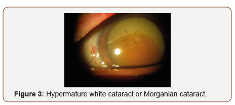 Click here to view Large Figure 3 irispublishers-openaccess-ophthalmology-vision-research