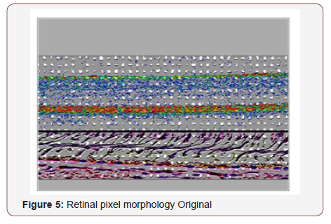 Click here to view Large Figure 5 irispublishers-openaccess-ophthalmology-vision-research