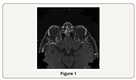 Click here to view Large Figure 1 irispublishers-openaccess-ophthalmology-vision-research