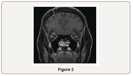 Click here to view Large Figure 2 irispublishers-openaccess-ophthalmology-vision-research