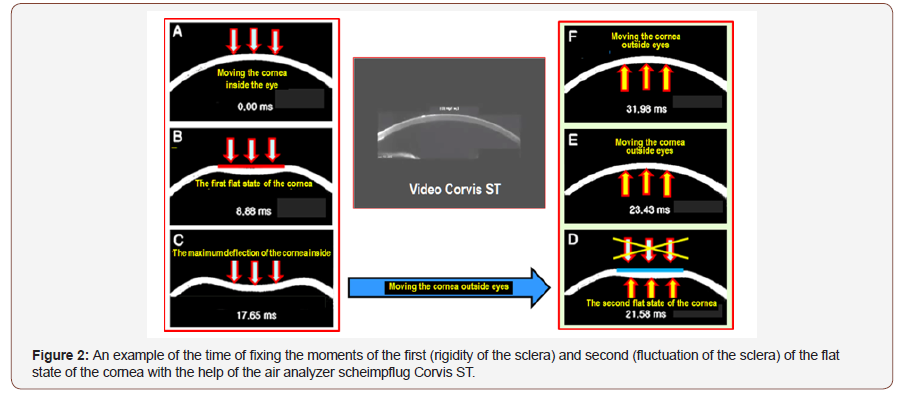 Click here to view Large Figure 2 irispublishers-openaccess-ophthalmology-vision-research