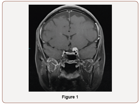 Click here to view Large Figure 1 irispublishers-openaccess-ophthalmology-vision-research