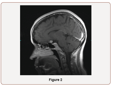 Click here to view Large Figure 2 irispublishers-openaccess-ophthalmology-vision-research