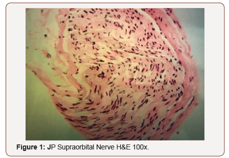 Click here to view Large Figure 1 irispublishers-openaccess-ophthalmology-vision-research